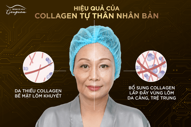 Công nghệ căng chỉ collagen không xâm lấn - Gold Fiber 
